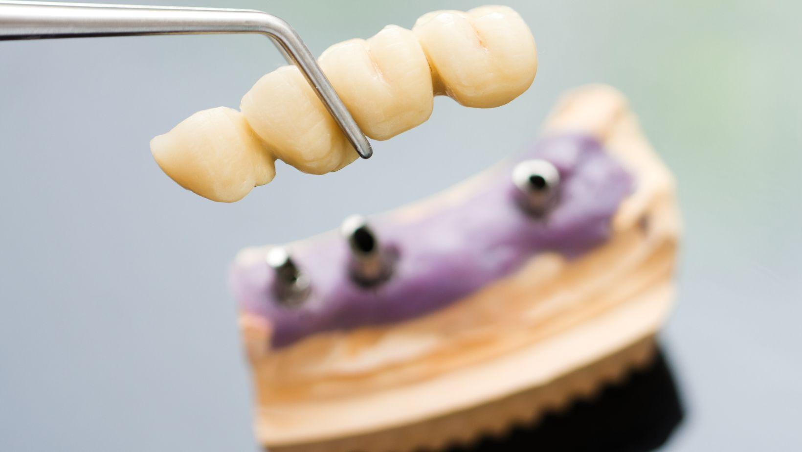 implant supported bridges, dental implants bridges, implant bridges cost, benefits of implant supported bridges, durable dental bridges, best implant bridges, implant supported dentures alternative, long-lasting dental restorations, affordable implant bridges, periodontist implant solutions