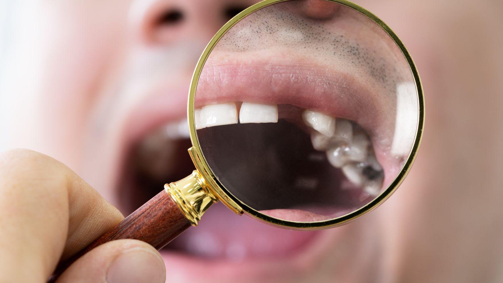 multiple missing teeth replacements, implant supported dentures, dental implant options, benefits of fewer implants, implant dentistry benefits, full mouth restoration implants, implant treatment considerations, reduce number of implants, affordable implant solutions, implant therapy advantages