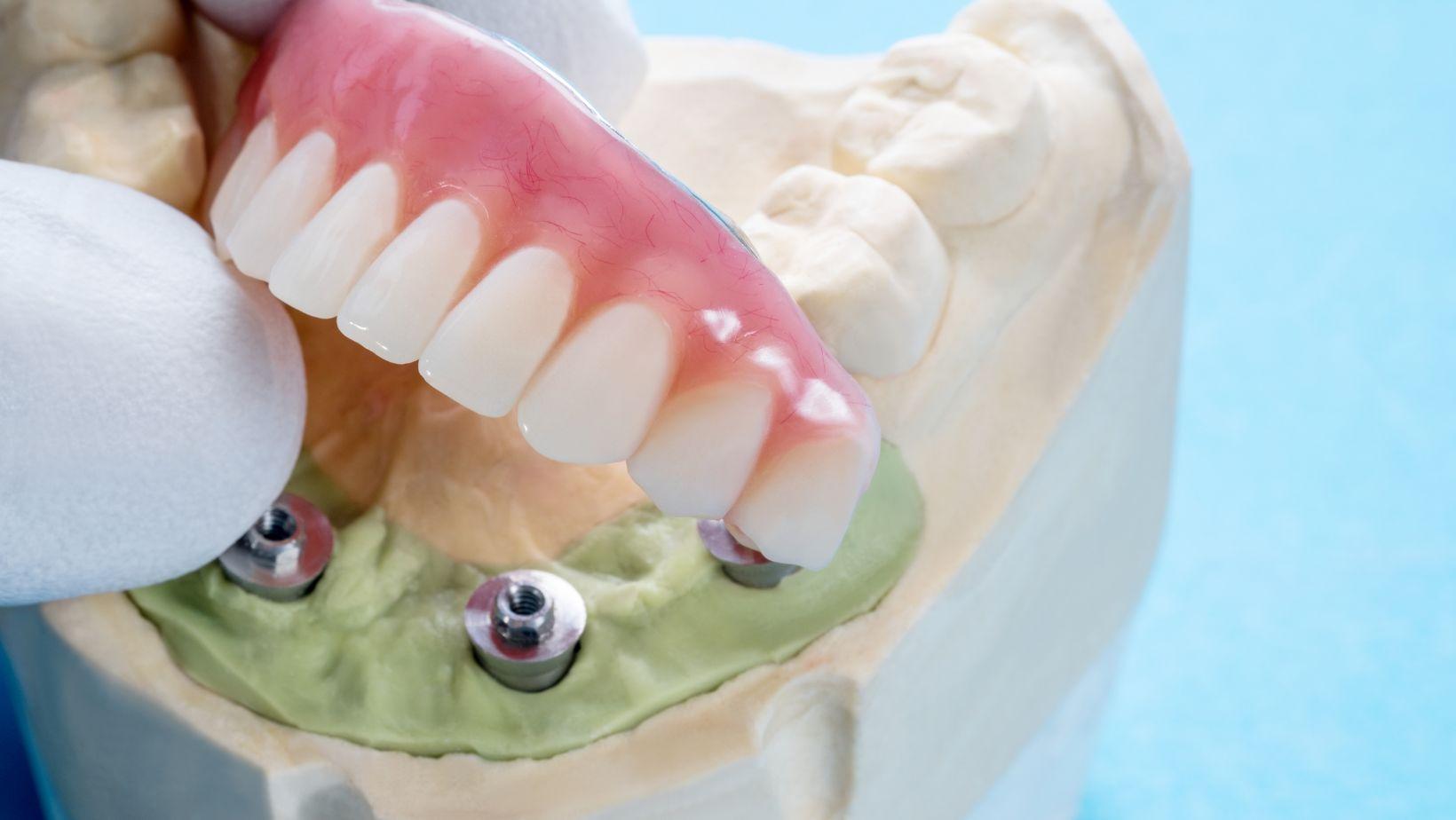 dental implants durability, implant lifespan comparison, denture longevity, dental implant costs, denture maintenance tips, long-term dental solutions, affordable dental implants, implant vs denture durability, implant maintenance costs